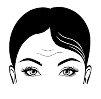 Forehead Thread Lift - Glabella Lift Toronto & Mississauga